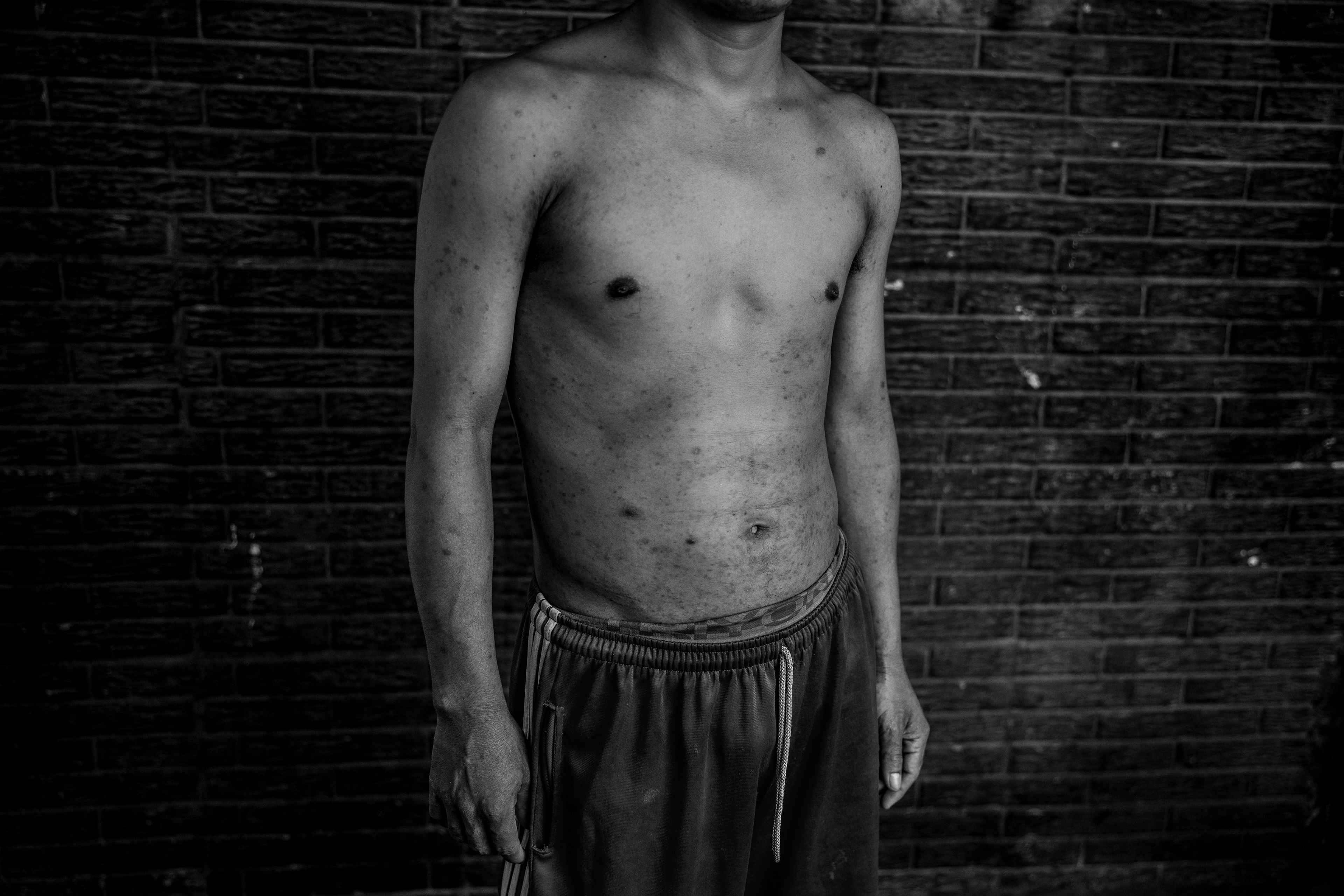 Samuel fue arrestado a pesar de su condición y, durante 13 meses, fue tratado con crueldad: recibió palizas de los guardias, castigos humillantes, sus compañeros de celda le robaron la comida y las medicinas, y fue obligado a vivir en condiciones aberrantes. Afirma haber visto a varios compañeros de celda suicidarse ahorcándose. Es un hombre con problemas mentales que fue capturado durante el régimen de excepción. En prisión, enfermó de la piel.